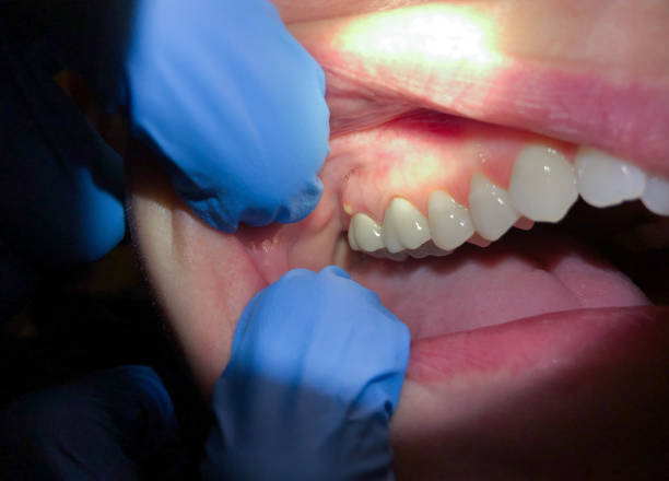 Best Emergency Dental Care for Sports Injuries in Plains, MT
