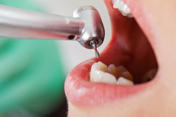Best Knocked-Out Tooth (Avulsed Tooth) Treatment in Plains, MT